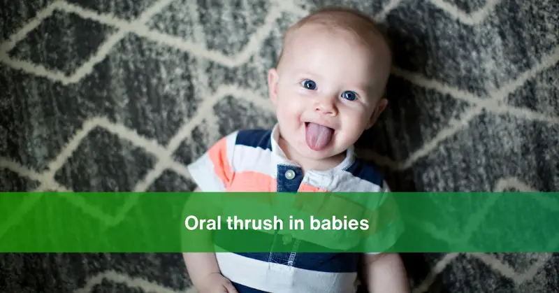 Oral Thrush in Babies