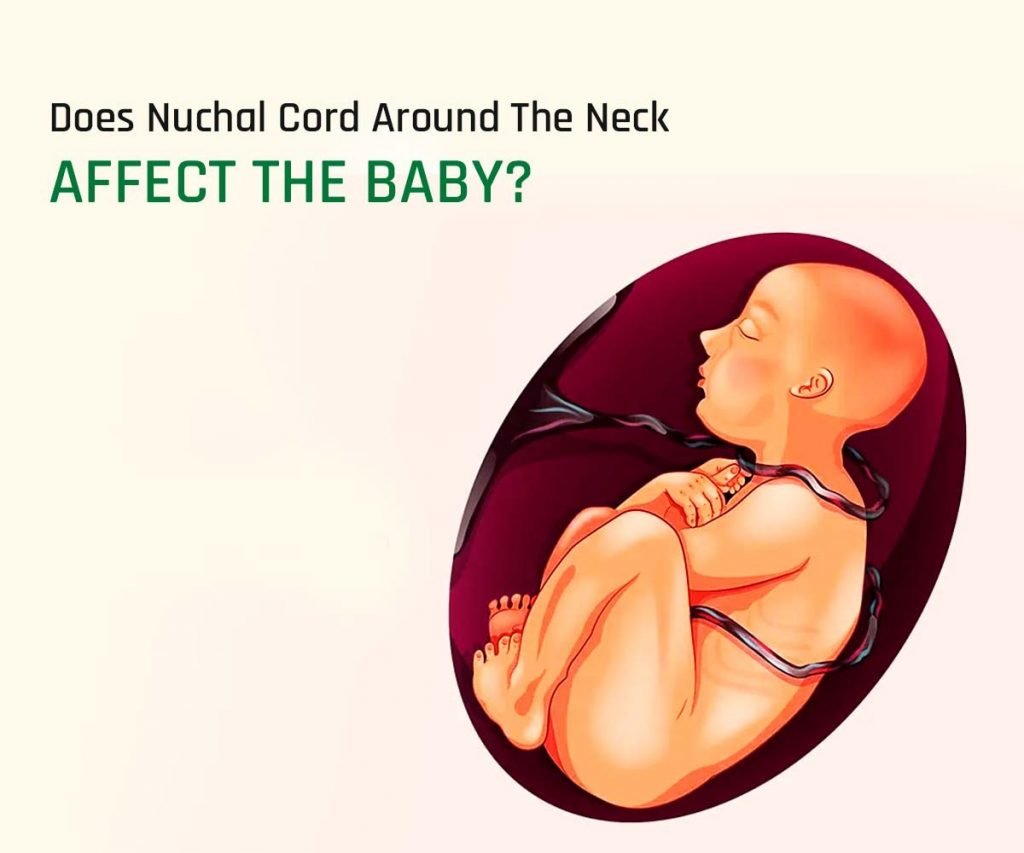 Does Nuchal Cord Around The Neck Affect The Baby