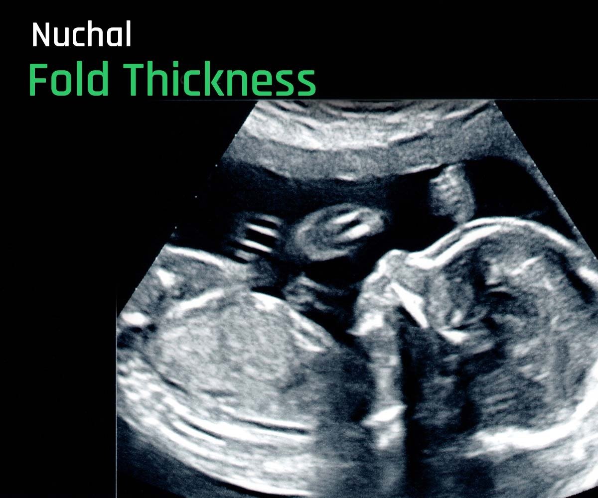 normal nuchal fold thickness