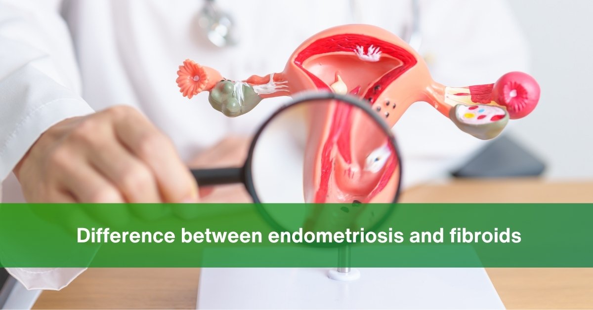 endometriosis and fibroids