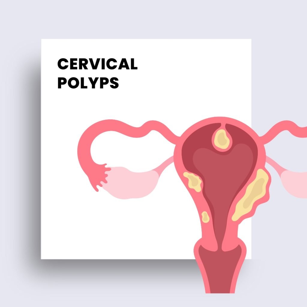 cervical polyps