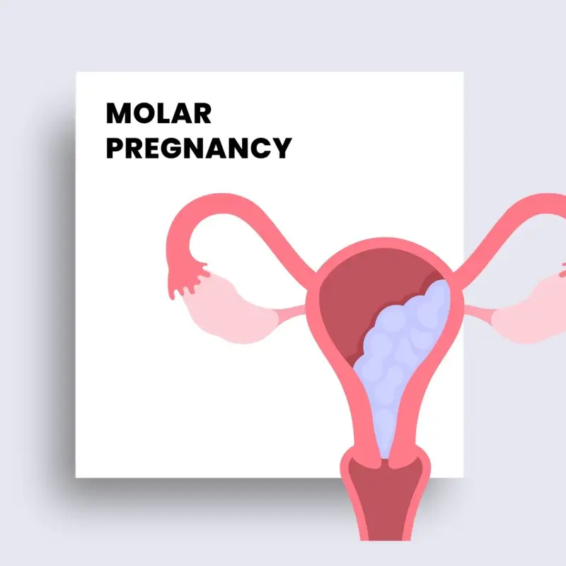 molar pregnancy