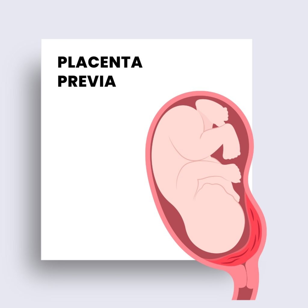 placenta previa - spotting