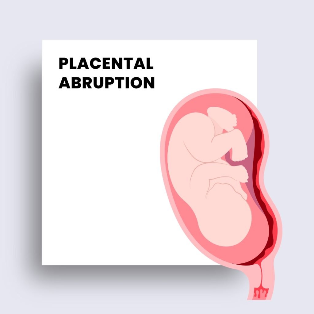 placental abruption