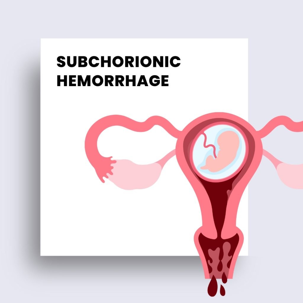 subchorionic hemorrhage