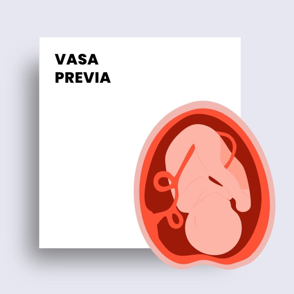 vasa previa