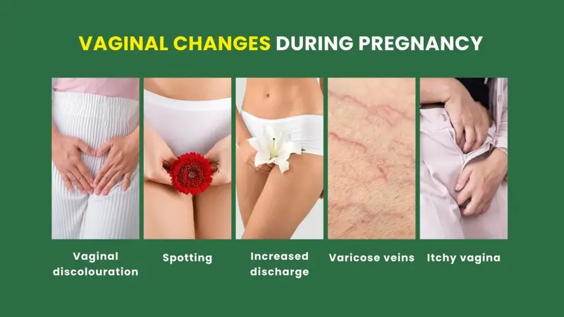 Vaginal changes during pregnancy