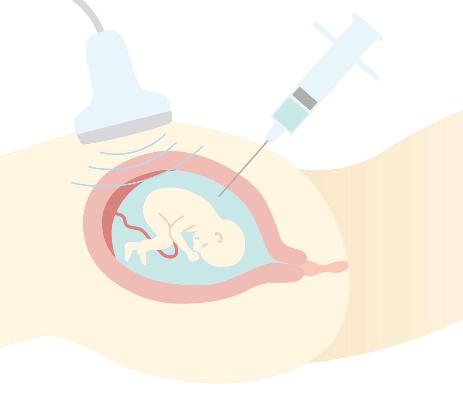 Amniocentesis test